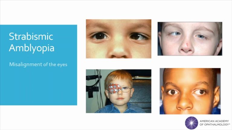 A Guide to Understanding and Treating Amblyopia: Expert Tips from Vision Care Specialists