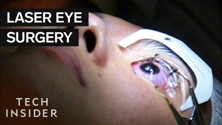 The Definitive Guide to Laser Eye Surgery: Everything You Need to Know About the Procedure and How to Prepare for It